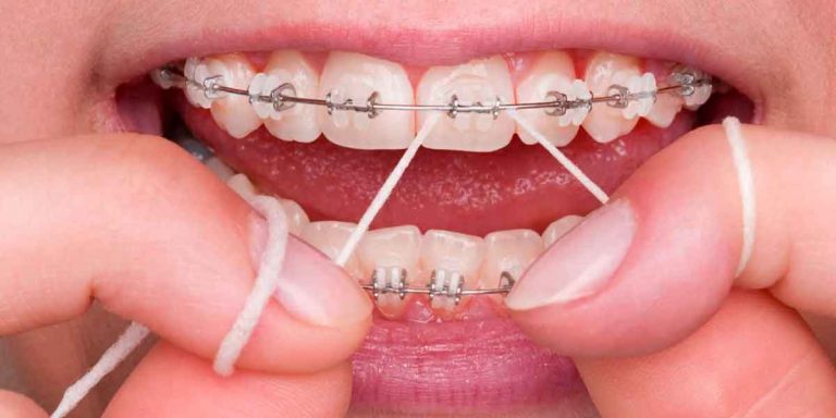 Dental Braces Worth the Effort